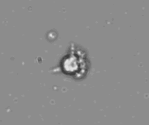 Image of complex subvisible particle consisting of silicone oil and protein